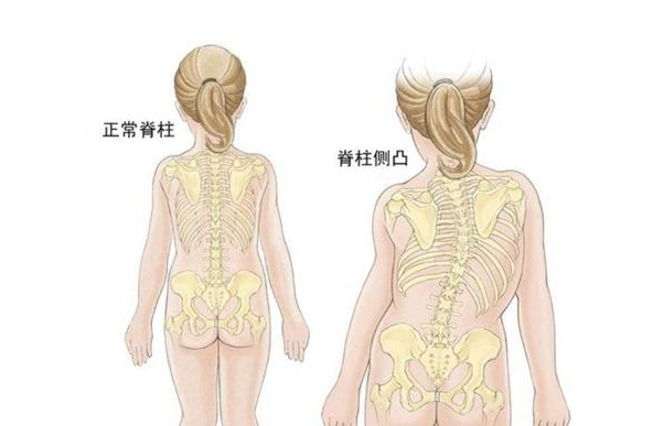 [國(guó)康資訊]兒童綜合素質(zhì)測(cè)試儀早發(fā)性脊柱側(cè)凸-兒童顯著的成長(zhǎng)和發(fā)育障礙